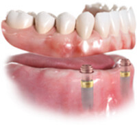 2本のインプラント+ロケーターを用いた入れ歯